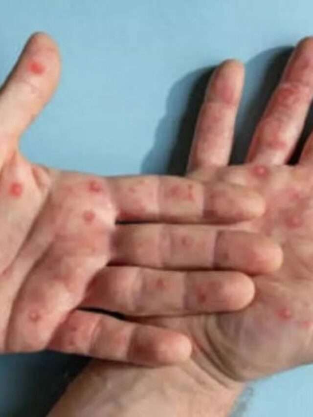Monkeypox Virus குரங்கம்மை பெருந்தொற்று பரவல்